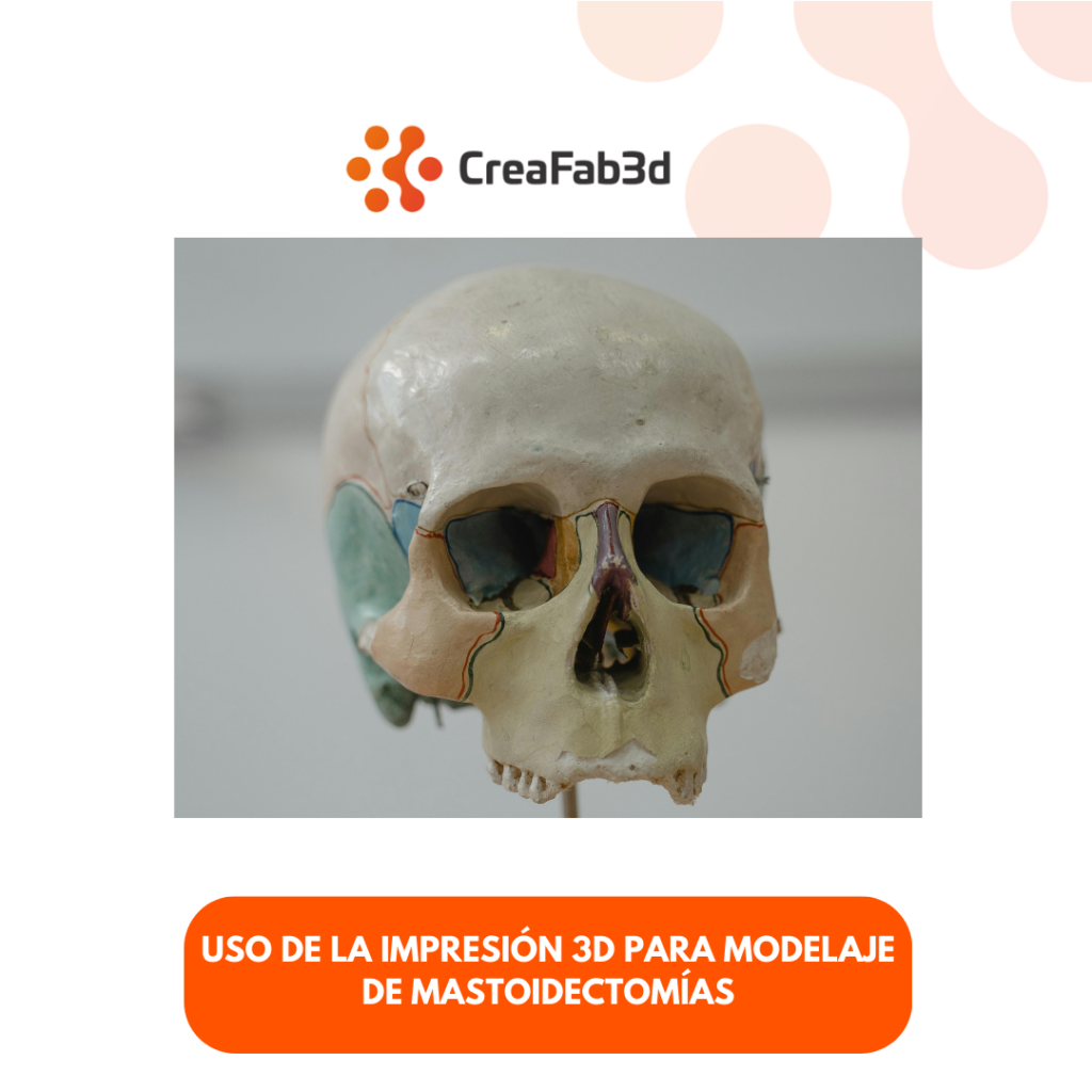 Mastoidectomía Impresión 3D